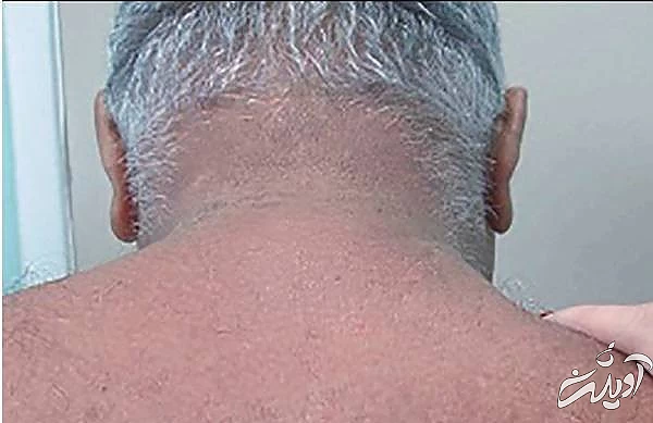 اسکلرودرما دیابتیکروم